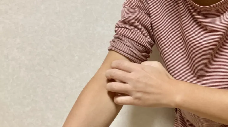 韓国でトコジラミに刺された時の対処法